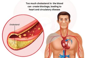 The Best Treatment for High Cholesterol