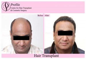Profile Forte Hair Transplant Ludhiana
